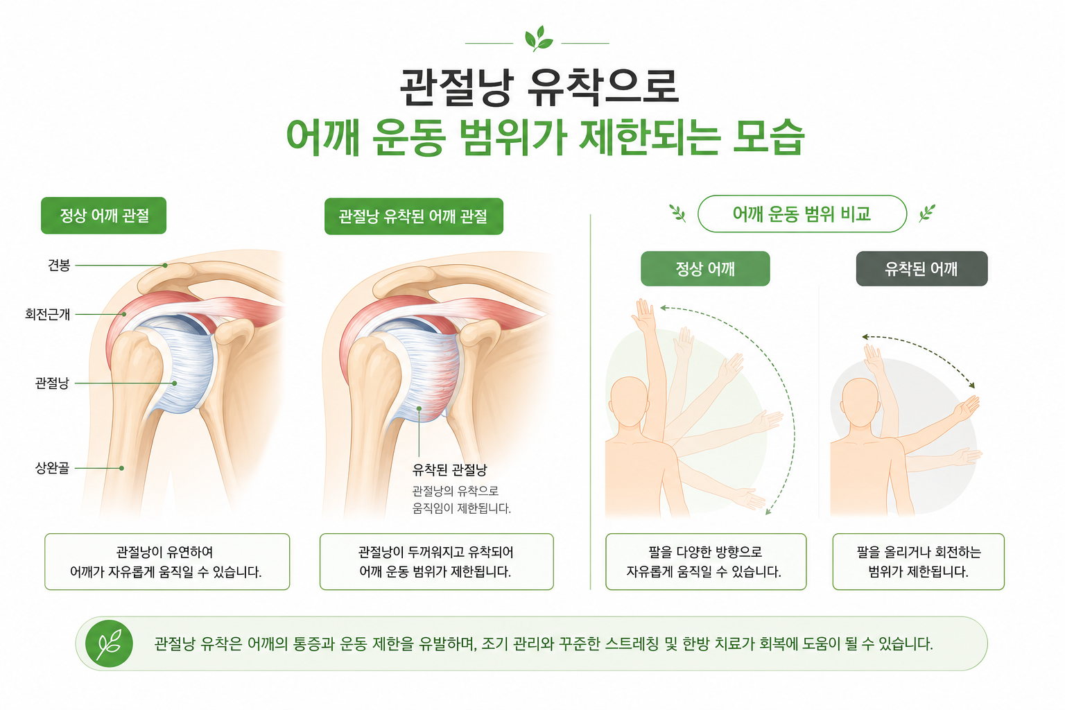 관절낭 유착으로 어깨 운동 범위가 제한되는 모습을 보여주는 인체 어깨 관절 구조 일러스트 오십견 회전근개 감별 이미지