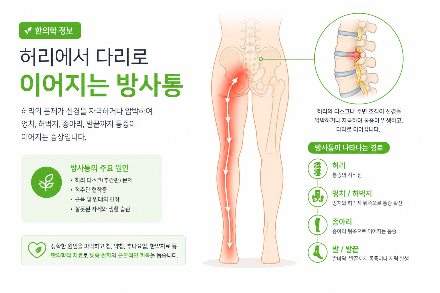 장거리 운전 허리 통증, 디스크일까요? 단순 근육통과의 차이 허리에서 다리로 이어지는 방사통 경로를 화살표로 표시한 인체 인포그래픽 이미지 운전 허리 통증 이미지